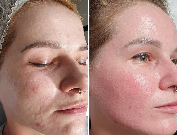 CO2 Laser Resurfacing Treatments in Belleair Beach, FL