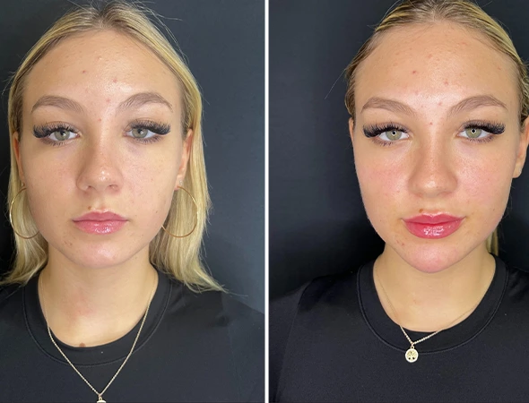 Allergan Dermal Fillers & Botox Experts in Belleair Beach, FL