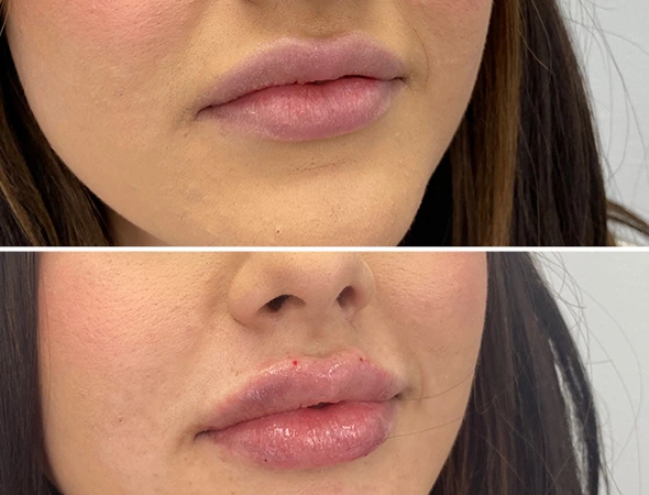 Harbor Bluffs, FL Allergan Dermal Fillers & Botox Experts-3