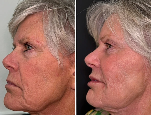 Injectables & Anti-Aging Solutions in Safety Harbor, FL-5