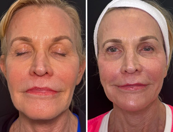 Injectables & Anti-Aging Solutions in Safety Harbor, FL-6