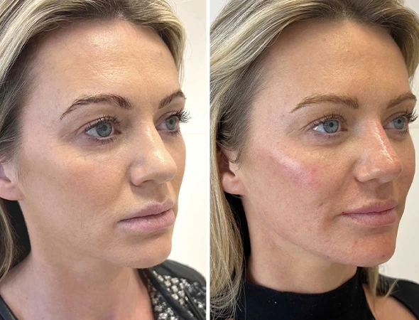 Sculptural Facials & Skin Rejuvenation in Belleair Shores, FL