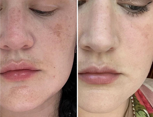 Sun Damage & Skin Damage Repair in Belleair Shores, FL