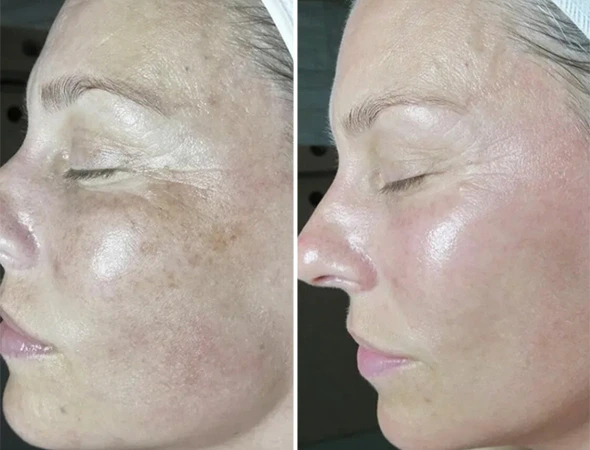 Safety Harbor, FL Sun Damage & Skin Damage Repair-4